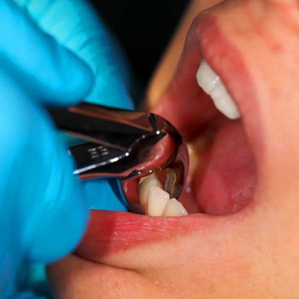 Extração Dentária