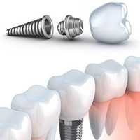 Implante Dentário Mobile
